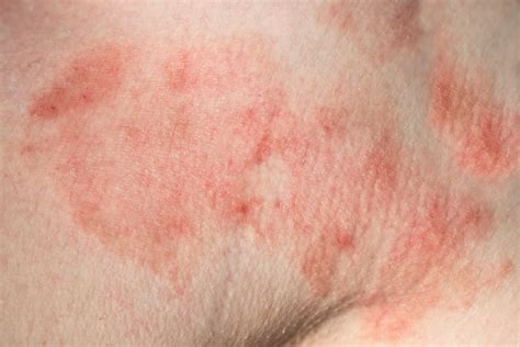 dermatitis por estres fotos - rentas cobradas por anticipado